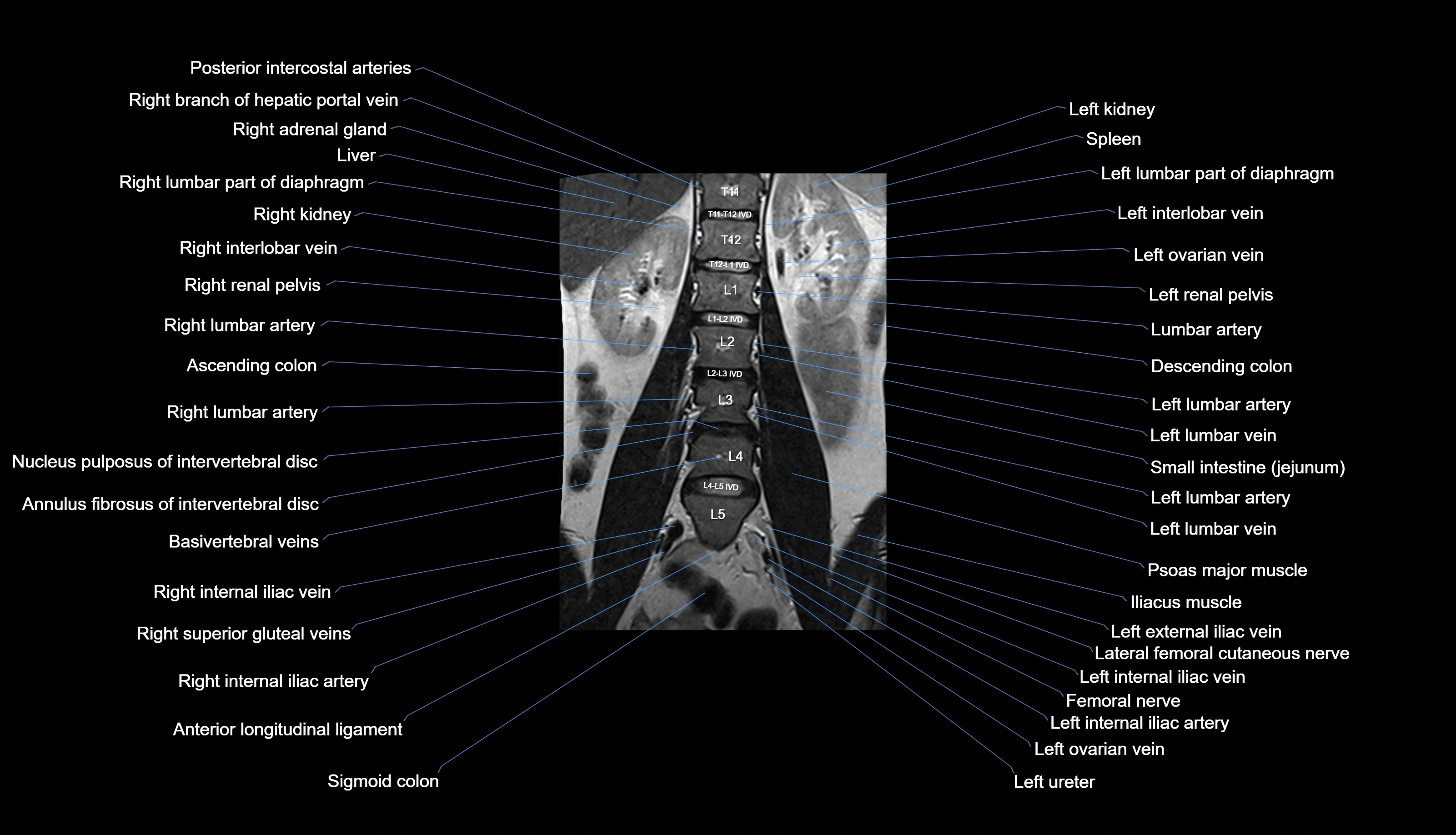 MRI lumbar spine labelled coronal cross sectional anatomy 3T radiology-img-00001-00014.webp